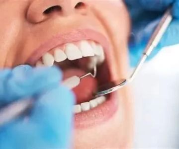 How to Prevent Plaque Buildup With Diet for Better Oral Health