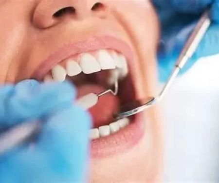 How to Prevent Plaque Buildup With Diet for Better Oral Health