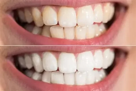 How to Whiten Teeth After Smoking