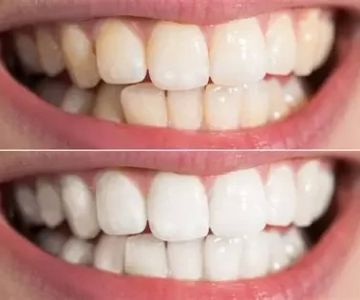 How to Whiten Teeth After Smoking