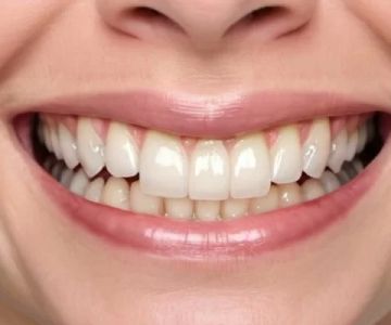 How to Decide If a Smile Makeover Is Right for You — Questions to Ask Before Committing