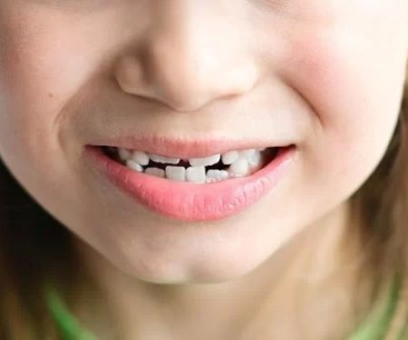 How to Recognize Jaw or Bite Alignment Issues in Children Early