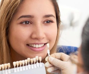 How to Choose the Right Shade for Dental Veneers or Crowns