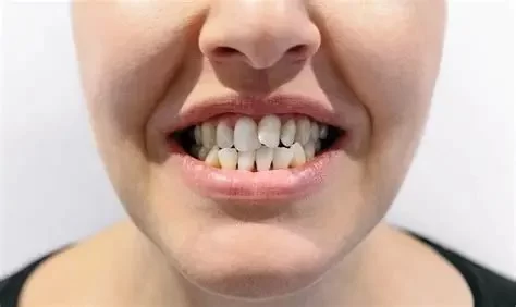 Can Teeth Shift Naturally After Braces? How to Prevent It