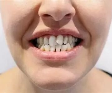 Can Teeth Shift Naturally After Braces? How to Prevent It