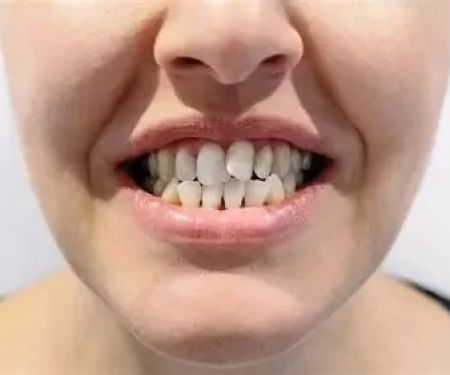 Can Teeth Shift Naturally After Braces? How to Prevent It