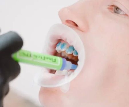 The Benefits of Fluoride for Children’s Teeth: Essential for Healthy Smiles