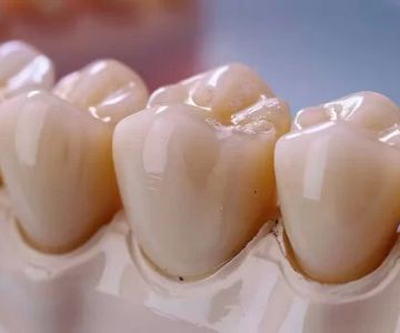 What Are Dental Crowns and How They Help Restore Your Teeth?