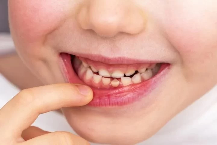 How to Handle a Loose Tooth in Children: A Parent’s Guide to Managing the Situation