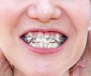 How to Deal with Crooked Teeth and Aligners: Treatment Options