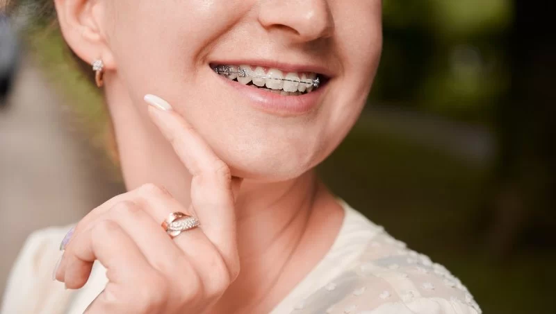 Everything You Need to Know About Orthodontic Braces