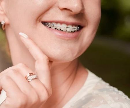 Everything You Need to Know About Orthodontic Braces