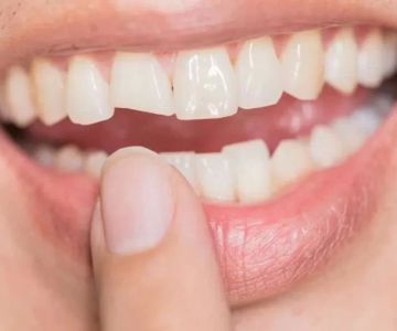 Best Practices for Cracked Tooth Repair for Smokers