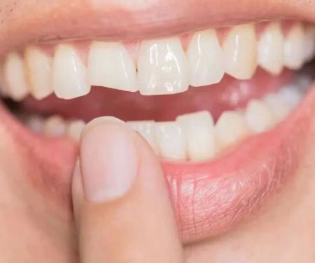 Best Practices for Cracked Tooth Repair for Smokers