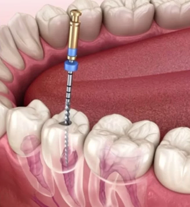 Step-by-Step Treatment Guide for Root Canal Treatment – Signs You Should See a Dentist