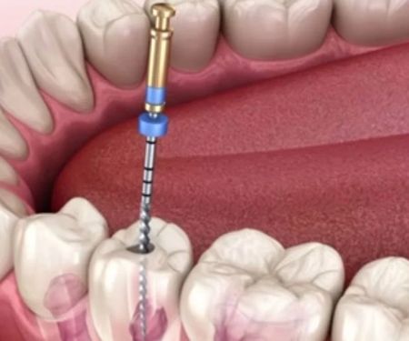 Step-by-Step Treatment Guide for Root Canal Treatment – Signs You Should See a Dentist