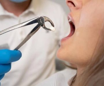Wisdom Teeth Removal for Patients with Diabetes: How to Choose the Right Approach