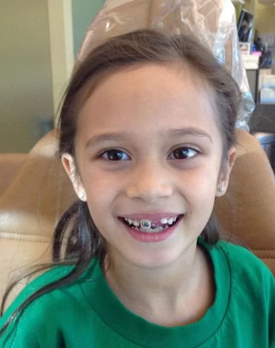 Long-Term Success of Mouthguards in the United States: At-Home vs Professional Options