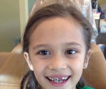 Long-Term Success of Mouthguards in the United States: At-Home vs Professional Options